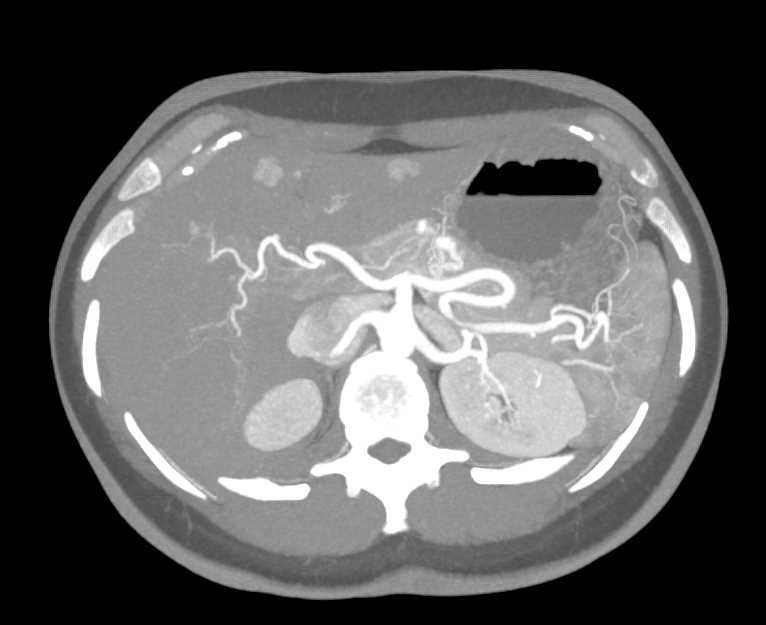 Hereditary Hemorrhagic Telangiectasia (HHT) Disease with AV Shunts in Liver and Pancreas - CTisus CT Scan