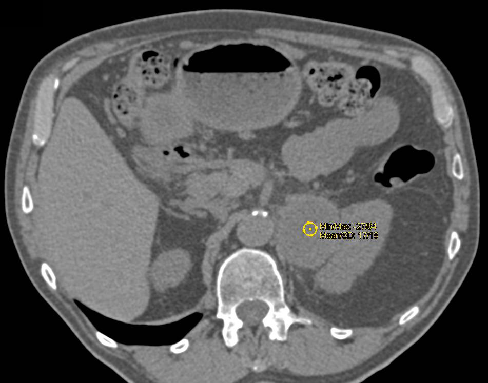Dilated Pancreatic Duct due to pancreatic Cancer with Cystic Metastases to the Left Adrenal Gland - CTisus CT Scan