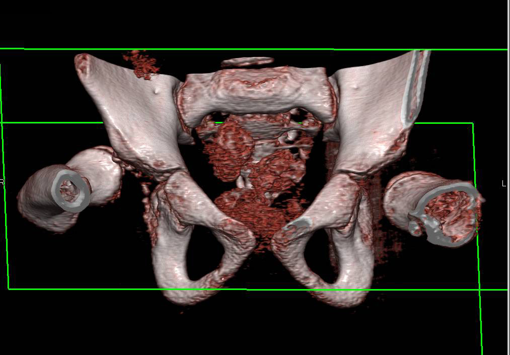 Congenital Hip Dysplasia - CTisus CT Scan