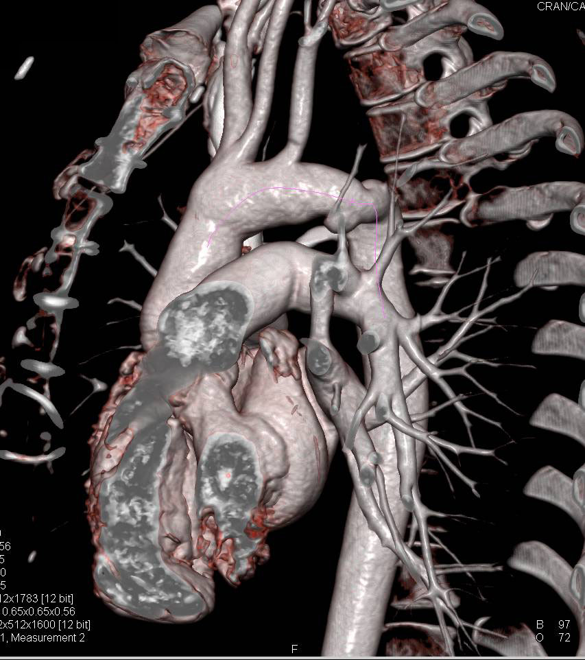 Prior Repair of a Coarctation of the Aorta - CTisus CT Scan