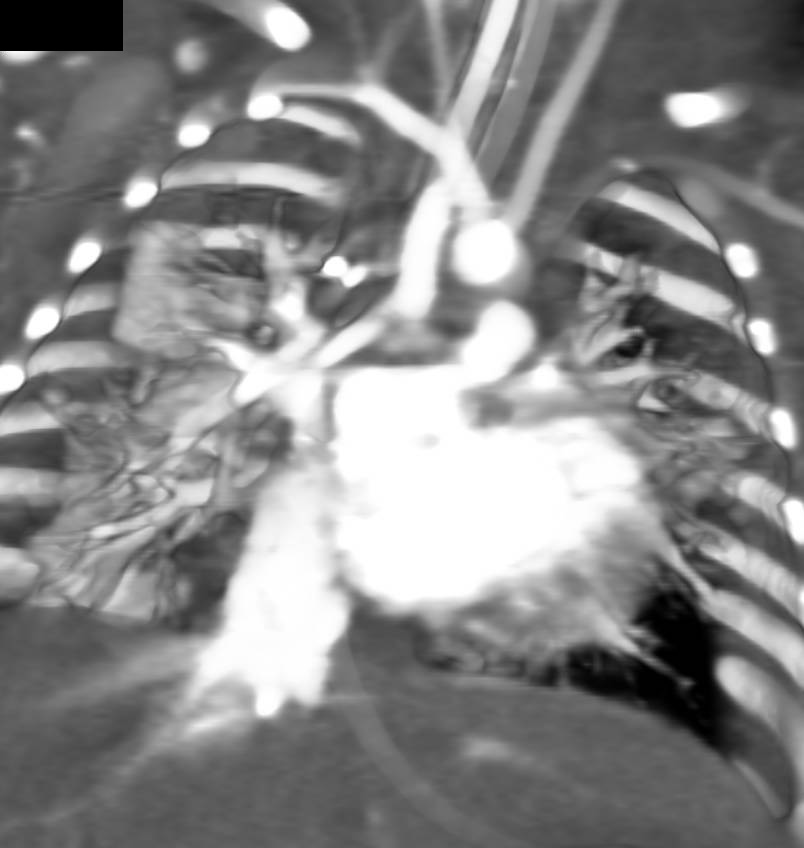 Nice 3D View of a Blalock Taussig Graft (BT) - CTisus CT Scan
