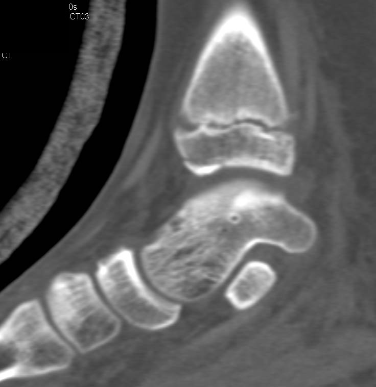 Tibial Fracture Through the Epiphyseal Plate - CTisus CT Scan