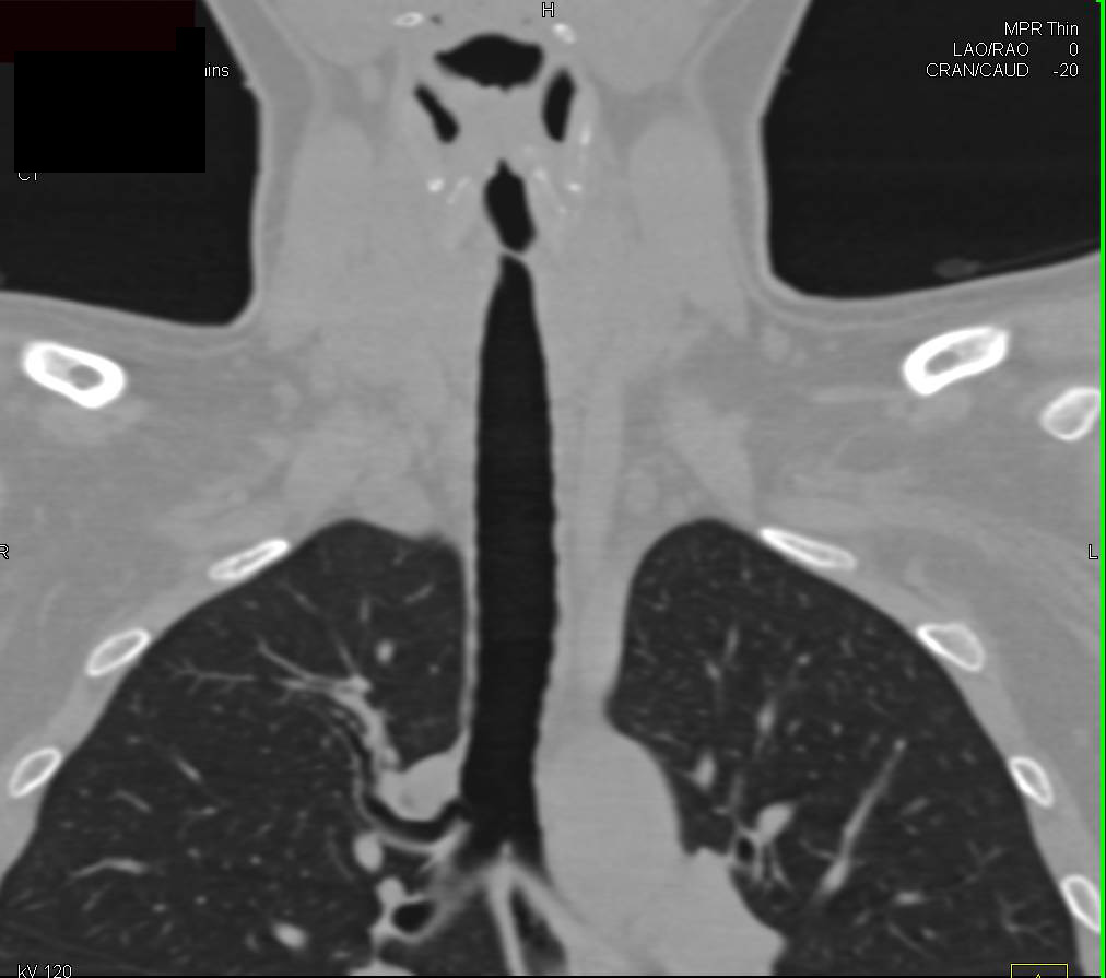 Airway Stenosis in 3D - CTisus CT Scan