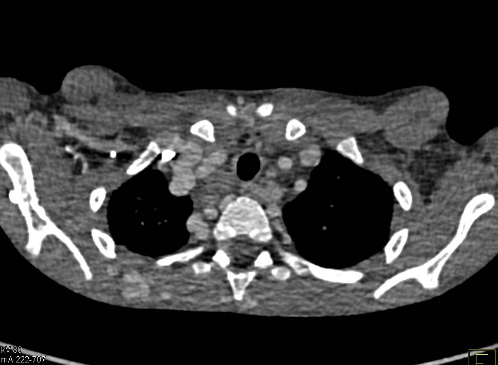 Mediastinal Collaterals in Congenital Heart Disease - CTisus CT Scan