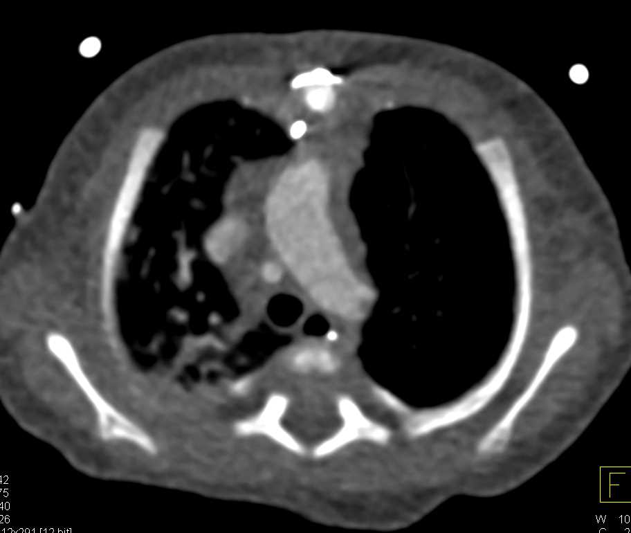 Dilated Cardiac Chambers in Congenital Heart Disease - CTisus CT Scan