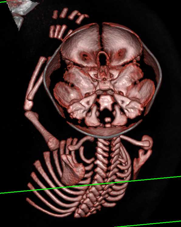 CT Evaluation of Fetus for Suspected Cranial Stenosis - CTisus CT Scan