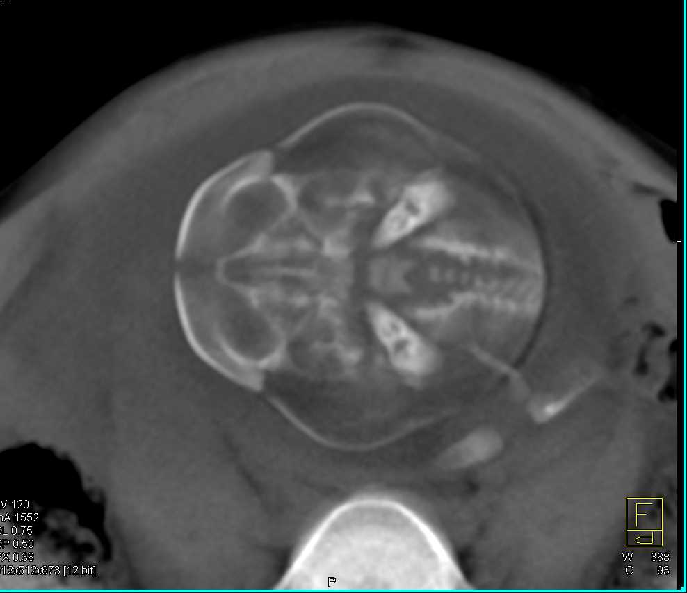 CT Evaluation of Fetus for Suspected Cranial Stenosis - CTisus CT Scan