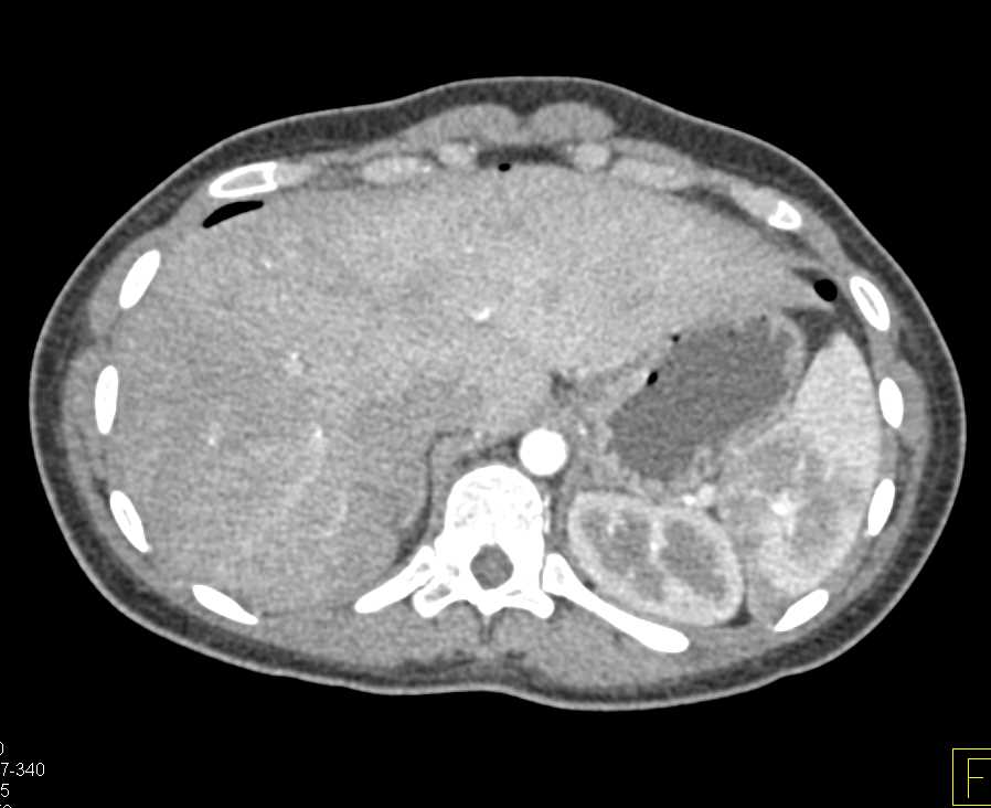 Postpartum Uterus - CTisus CT Scan