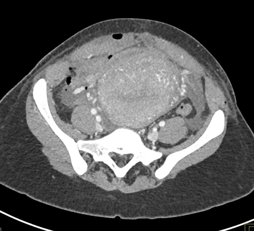 Postpartum Uterus - CTisus CT Scan