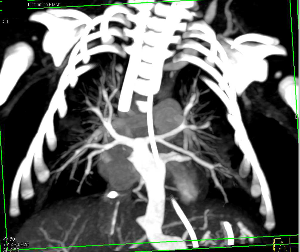 Aspiration Pneumonia in Patient with Congenital Heart Disease - CTisus CT Scan