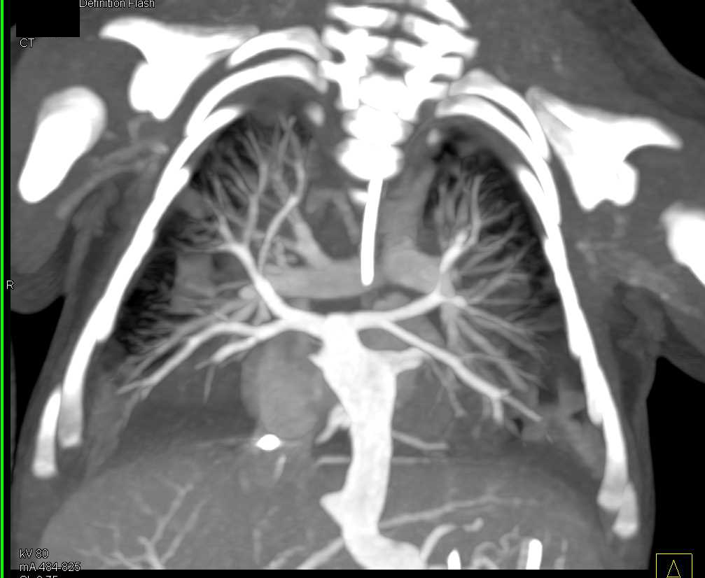 Aspiration Pneumonia in Patient with Congenital Heart Disease - CTisus CT Scan