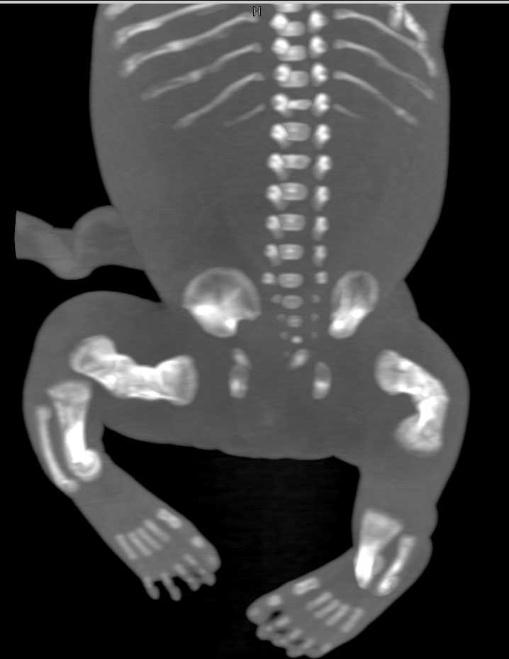 Osteogenesis Imperfecta - CTisus CT Scan