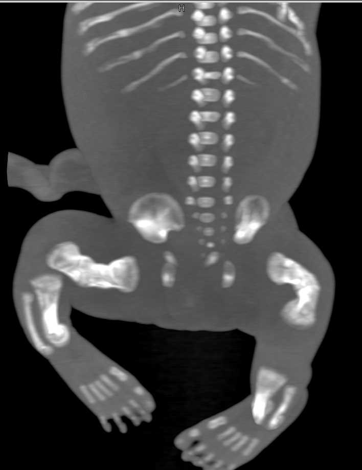 Osteogenesis Imperfecta - CTisus CT Scan