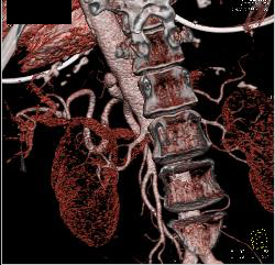 Dissection Involves the SMA - CTisus CT Scan