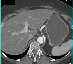 Dissection Involves the SMA - CTisus CT Scan