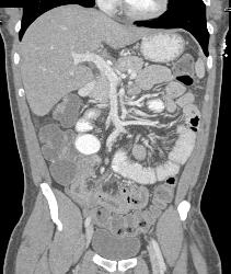 Small Bowel Obstruction (SBO) Due to Crohn's Disease - CTisus CT Scan