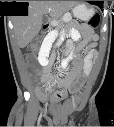 Small Bowel Obstruction (SBO) Due to Crohn's Disease - CTisus CT Scan