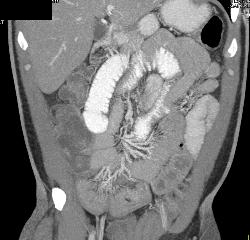 Small Bowel Obstruction (SBO) Due to Crohn's Disease - CTisus CT Scan