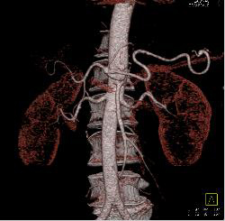 Celiac Stenosis Due to Median Arcuate Ligament Syndrome - CTisus CT Scan