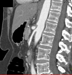 Celiac Stenosis Due to Median Arcuate Ligament Syndrome - CTisus CT Scan