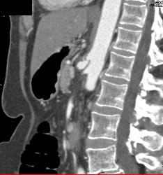 Celiac Stenosis Due to Median Arcuate Ligament Syndrome - CTisus CT Scan