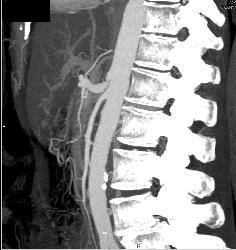 Superior Mesenteric Artery (SMA) Syndrome - CTisus CT Scan