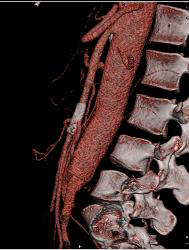 Superior Mesenteric Artery (SMA) Syndrome With Stent in SMA - CTisus CT Scan