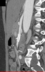 Superior Mesenteric Artery (SMA) Syndrome With Stent in SMA - CTisus CT Scan