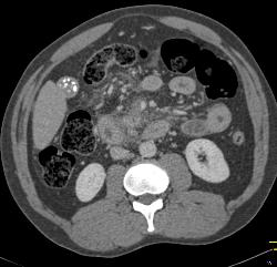 Sclerosing Mesenteritis in Mesentery - CTisus CT Scan