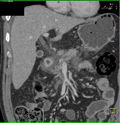 Sclerosing Mesenteritis in Mesentery - CTisus CT Scan