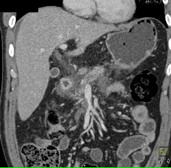 Sclerosing Mesenteritis in Mesentery - CTisus CT Scan