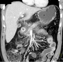 Sclerosing Mesenteritis in Mesentery - CTisus CT Scan