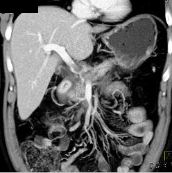 Sclerosing Mesenteritis in Mesentery - CTisus CT Scan