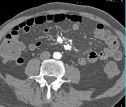 Sclerosing Mesenteritis Simulates A Carcinoid - CTisus CT Scan