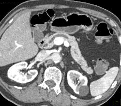 Intraductal Papillary Mucinous Neoplasm (IPMN) With A Nodule - CTisus CT Scan