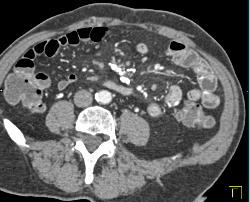 Sclerosing Mesenteritis - CTisus CT Scan