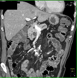 Sclerosing Mesenteritis in Mesentery - CTisus CT Scan