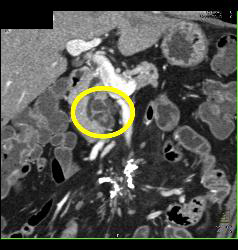 Sclerosing Mesenteritis in Mesentery - CTisus CT Scan