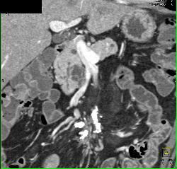 Sclerosing Mesenteritis in Mesentery - CTisus CT Scan