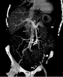 Sclerosing Mesenteritis - CTisus CT Scan