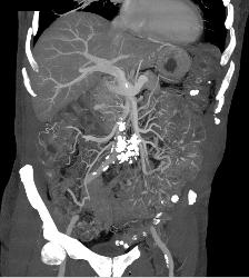 Sclerosing Mesenteritis - CTisus CT Scan