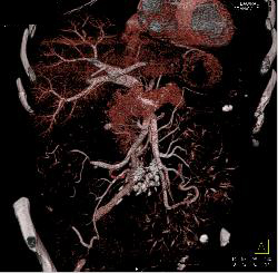 Sclerosing Mesenteritis - CTisus CT Scan