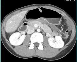 Fluid Lesser Sac Due to Prior Pancreatitis as Well as Abdominal Desmoids - CTisus CT Scan