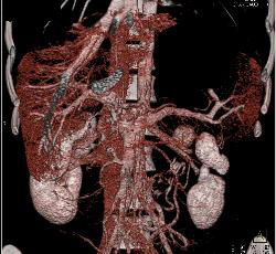 Superior Mesenteric Artery (SMA) Syndrome With Obstructed Duodenum - CTisus CT Scan