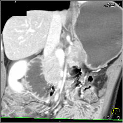 Superior Mesenteric Artery (SMA) Syndrome With Obstructed Duodenum - CTisus CT Scan