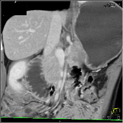 Superior Mesenteric Artery (SMA) Syndrome With Obstructed Duodenum - CTisus CT Scan