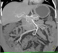 Celiac Artery Dissection - CTisus CT Scan