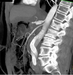 Celiac Artery Dissection - CTisus CT Scan