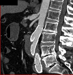 Celiac Artery Dissection - CTisus CT Scan