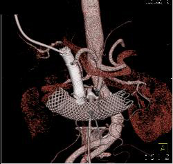 Stent in Common Bile Duct (CBD) and in Duodenum in Pancreatic Cancer - CTisus CT Scan